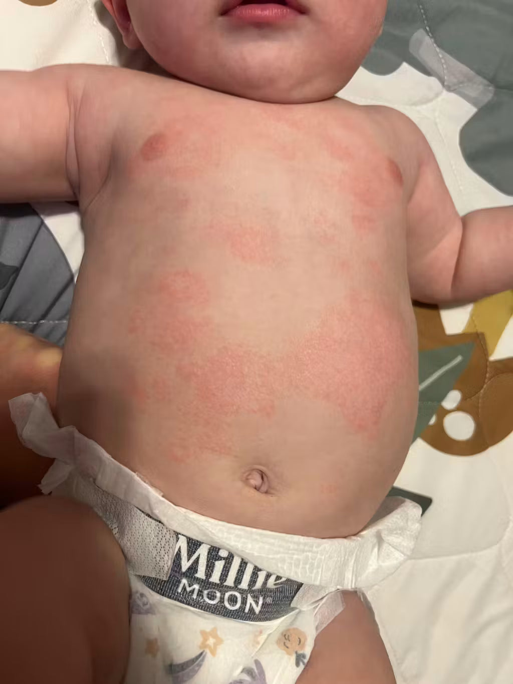 What Causes Baby Eczema?